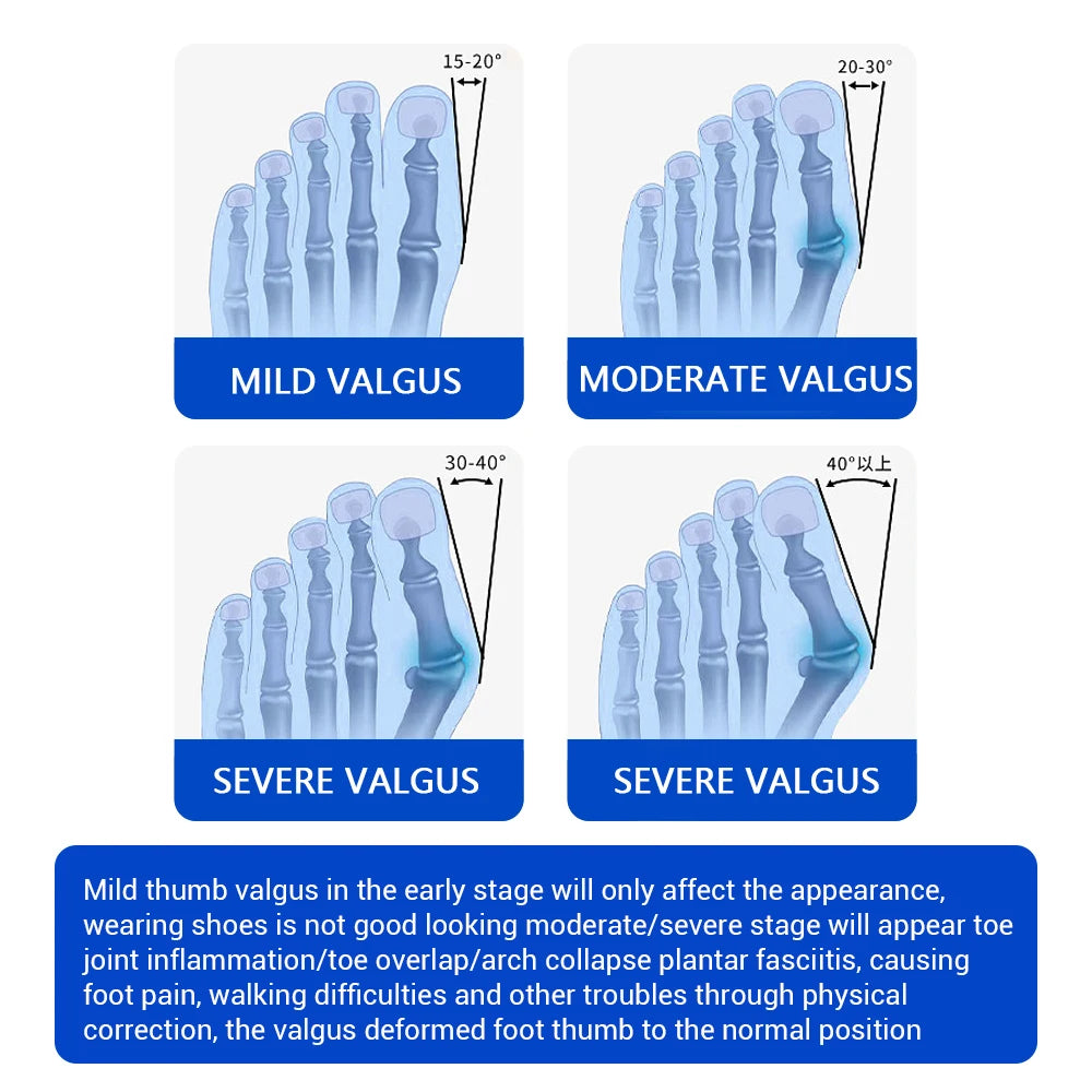 Moajaza Adjustable Bunion Toe Straightener